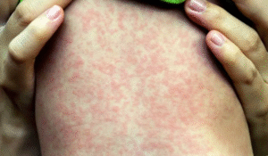 Confirman caso de sarampión en La Piedad.